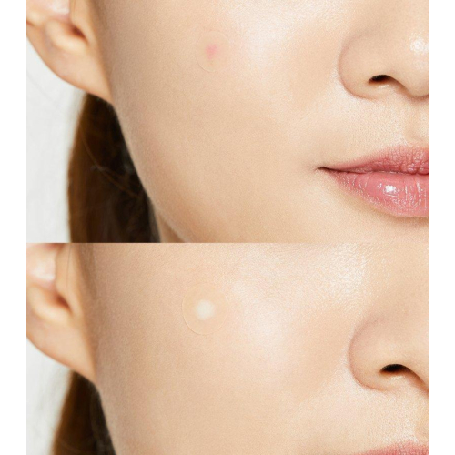 COSRX - Parches para imperfecciones Acne Pimple Master Patch
