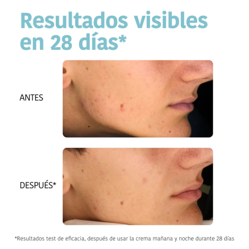 Iroha Nature - *Acne Prone Skin* - Crema facial Oil Control - Pieles acnéicas