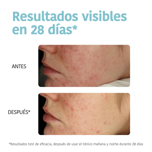 Iroha Nature - *Acne Prone Skin* - Discos tónico exfoliantes - Pieles acnéicas