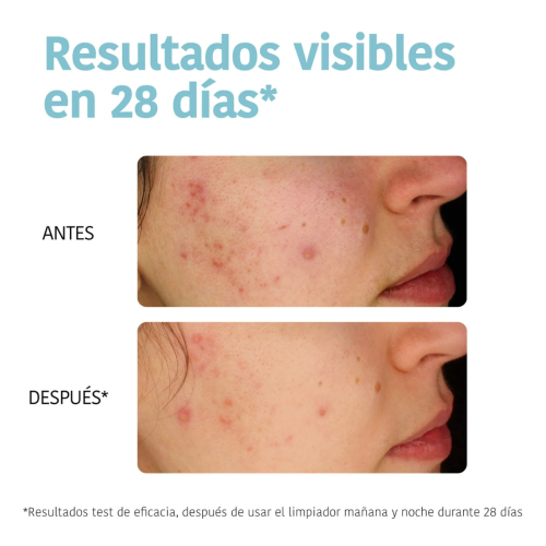 Iroha Nature - *Acne Prone Skin* - Limpiador purificante - Pieles acnéicas