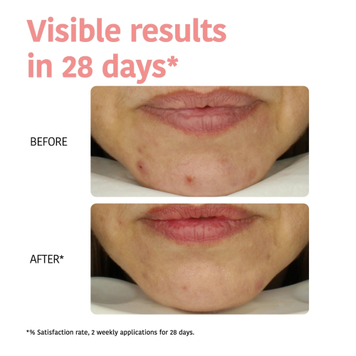 Iroha Nature - Mascarilla Perfect Skin Peeling - Ácido Glicólico