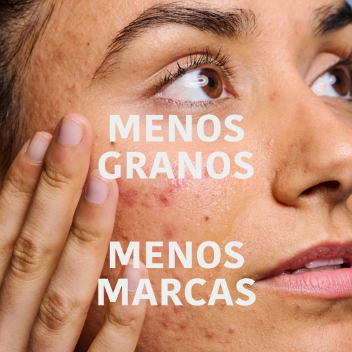 Iroha Nature - *Acne Prone Skin* - Sérum facial Prevent & Correct - Pieles acnéicas