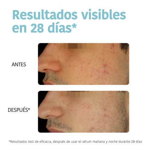 Iroha Nature - *Acne Prone Skin* - Sérum facial Prevent & Correct - Pieles acnéicas