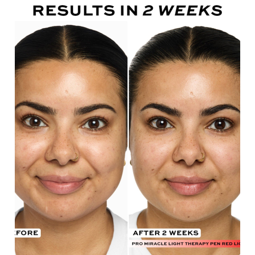 Revolution Pro - Dispositivo de fototerapia LED Pro Miracle