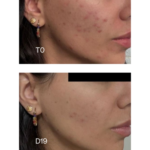 Sensilis - *Oily Skin* - Concentrado anti-imperfecciones Pure 15AZ